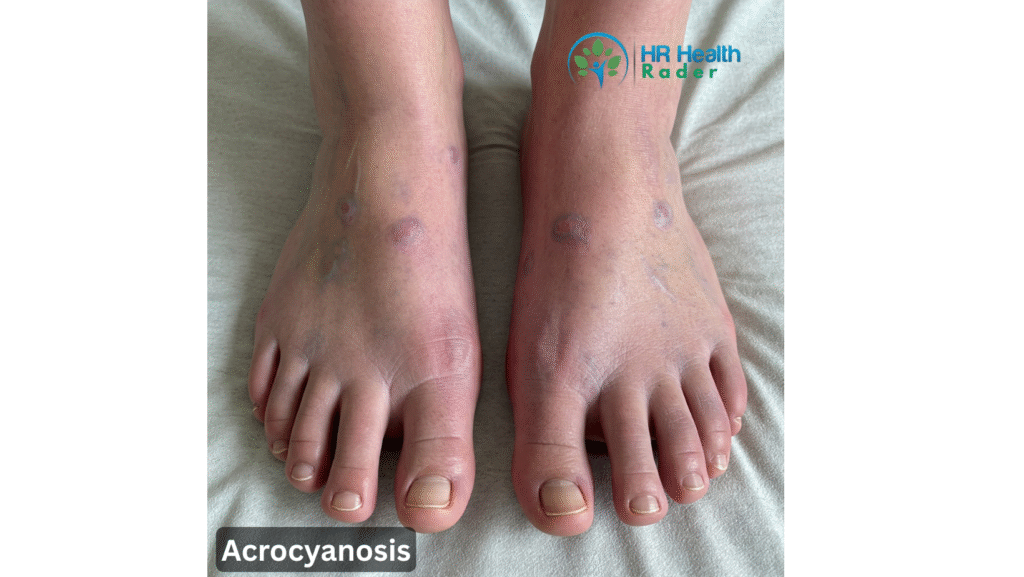 Acrocyanosis