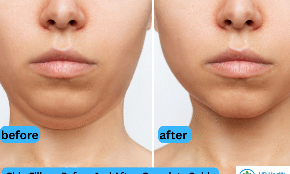 Chin Fillers before and after