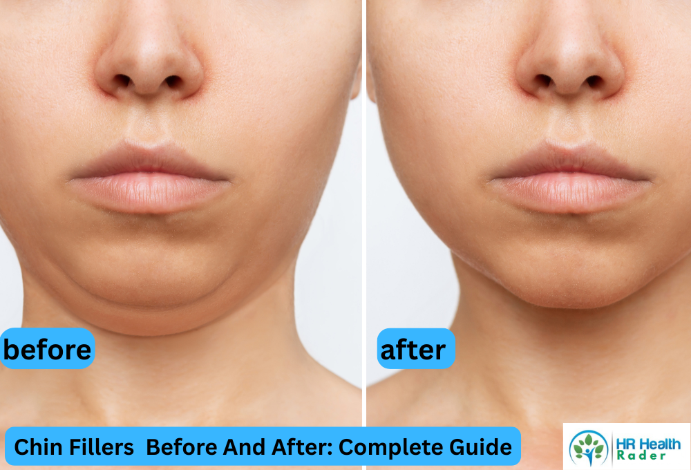 Chin Fillers before and after